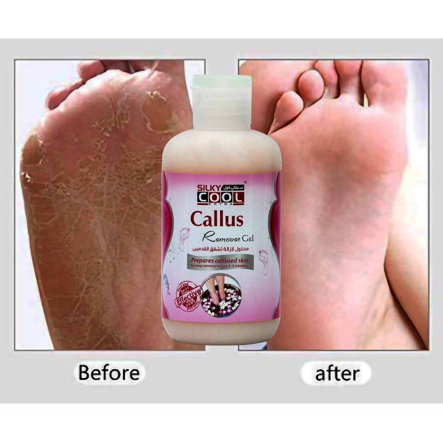 PILOT Silky Cool Callus Remover | Anti Crack Gel Treatment For Feet Curing Cuticles, Corn & Removing Callus Pedicure Treatment - Works In 5 Minutes - (Size 250 ml)